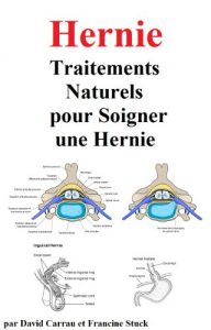 Baixar Hernie : Traitements Naturels pour Soigner une Hernie (French Edition) pdf, epub, eBook