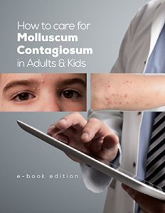 Baixar How to care for Molluscum Contagiosum in Adults and Kids. (English Edition) pdf, epub, eBook