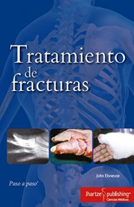 Baixar TRATAMIENTO DE FRACTURAS (Spanish Edition) pdf, epub, eBook