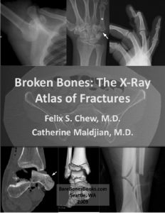 Baixar Broken Bones: The X-Ray Atlas of Fractures (English Edition) pdf, epub, eBook