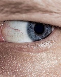 Baixar Lasik pdf, epub, eBook